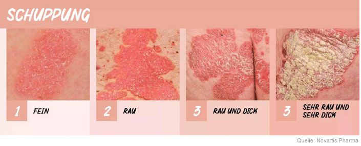 Psoriasis Schuppung