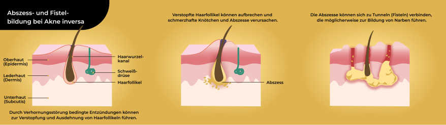 Illustration der Abszess- und Fistelbildung bei Akne inversa
