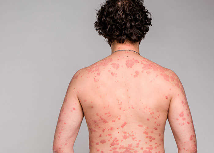 Psoriasis Symptome Teaser