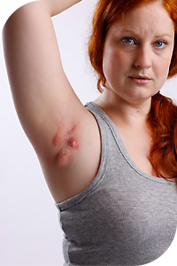 Akne inversa Stadium 1