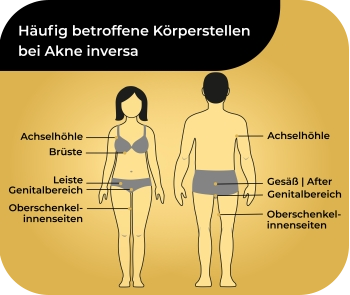 llustration von Frau und Mann mit häufig betroffenen Körperstellen bei Akne inversa