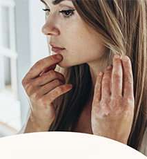 Teaser Psoriasis Patientenbroschüre